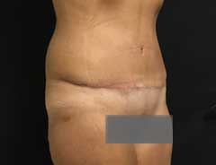 full tummy tuck - tween - after