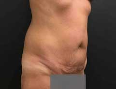 full tummy tuck - tween - before