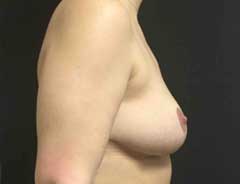 Side view, breast lift, after