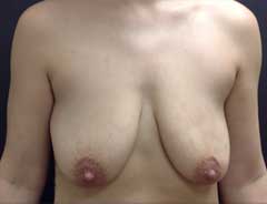 Front view, breast lift, before