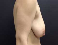 Side view, breast lift, before