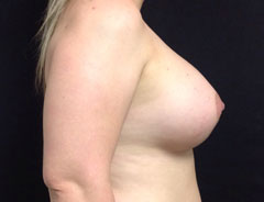 Breast Aug, Side, 38D