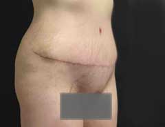 Angle view, tummy tuck full, after
