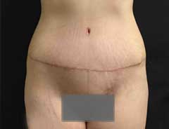 Front view, tummy tuck full, after