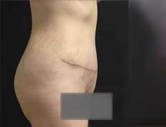 Side view, tummy tuck full, after