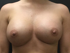 Breast Aug, Front, 34D