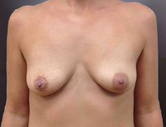 Breast Aug front before