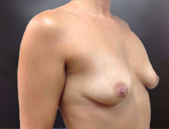 Breast Aug middle before