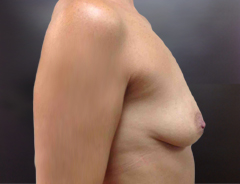 Breast Aug side view before