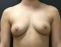 Breast Aug, Front, 34B