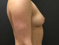 Breast Aug, Side, 34B