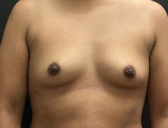 Breast Aug, Front, 34A