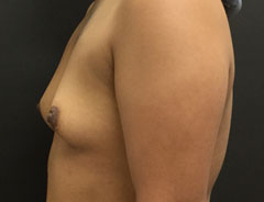 Breast Aug, Side, 34A