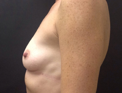 Side View, Breast Augmenation, Before: 34A
