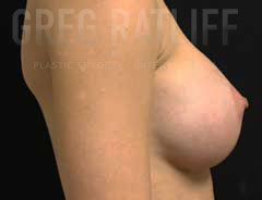 Side view, breast augmentation, after