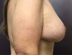 After Breast Lift side