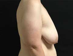 Before Breast Lift side