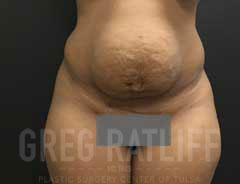 full tummy tuck - front - before