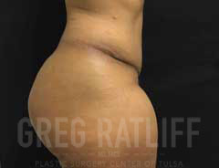 full tummy tuck - side - after