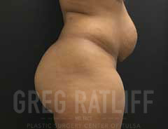 full tummy tuck - side - before