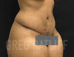 full tummy tuck - tween - after