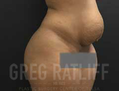 full tummy tuck - tween - before