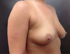 Angle view, breast augmentation before: 34B