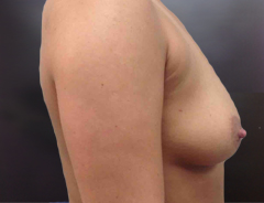 Side View, Breast Augmenation, Before: 34B