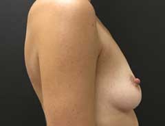 Side view, breast augmentation, before