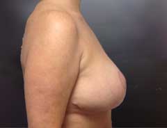 After Breast Lift side