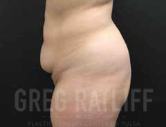 full tummy tuck - side - before