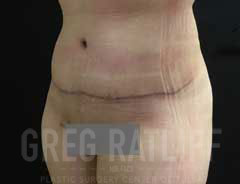 full tummy tuck - tween - after