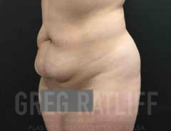 full tummy tuck - tween - before