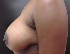 Side View, Breast Augmenation, After: 38D Full
