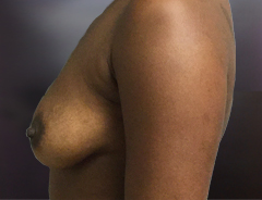 Side View, Breast Augmenation, Before: 36B