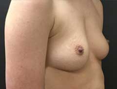 Angle view, breast augmentation, before