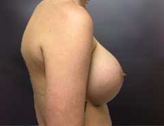 Side view, breast augmentation, after