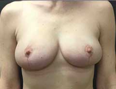 After Breast Lift front