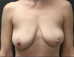 Before Breast Lift front