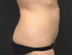 BodyTite-adbomen after