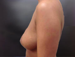 Side View, Breast Augmenation, Before: 32B