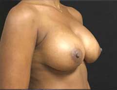 Angle view, breast augmentation, after