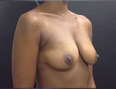 Angle view, breast augmentation, before