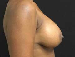 Side view, breast augmentation, after