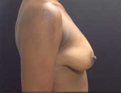 Side view, breast augmentation, before
