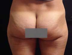 After Liposuction back