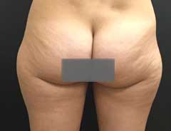 Before Liposuction back