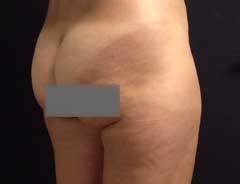 After Liposuction side
