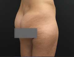 Before Liposuction side