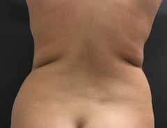 BodyTite-hips before